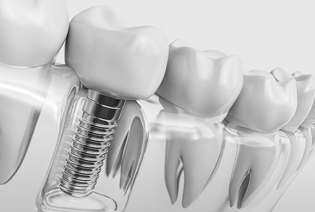 Dental Implants